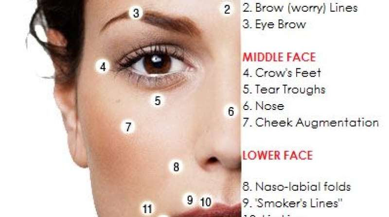 What are Dermal Fillers?