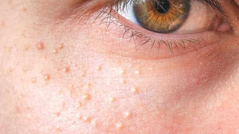 Milia Removal Using Cryotherapy