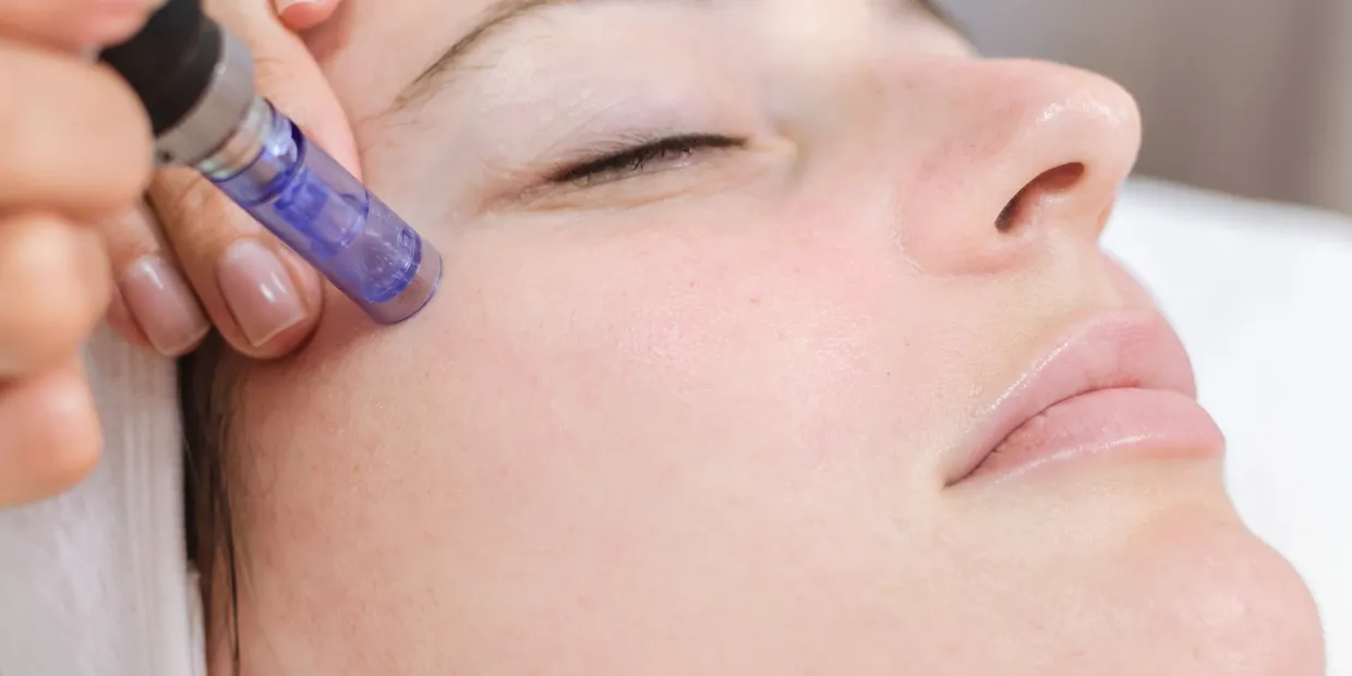 The Benefits of Medical Microneedling