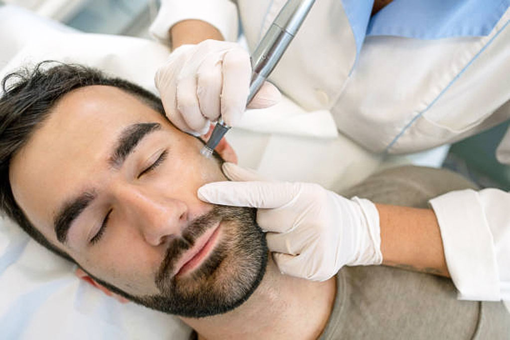 Microneedling For Men Belfast