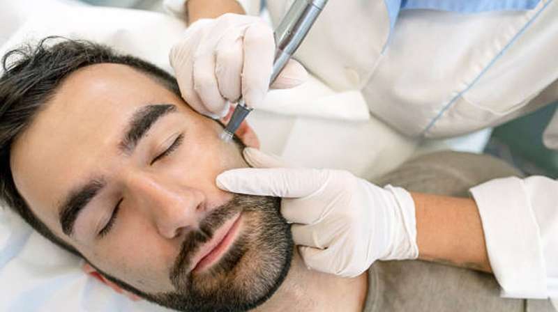 Microneedling For Men: What Exactly Is Microneedling and How Does It Benefit Men's Skin?