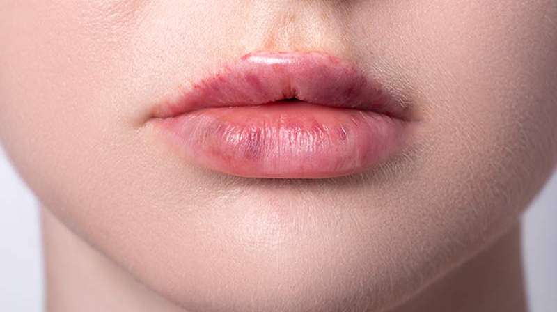 Will I Bruise After an Injectable Treatment? (And How to Prevent It)